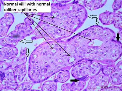 Impact of COVID-19 during pregnancy on placental pathology, maternal and neonatal outcome – A cross-sectional study on anemic term pregnant women from a tertiary care hospital in southern India